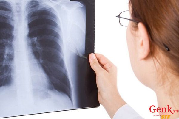 Ung thư phổi di căn lên não