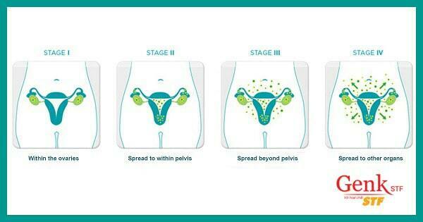 Các giai đoạn ung thư buồng trứng