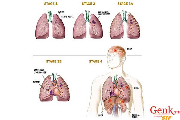 Các giai đoạn của bệnh ung thư phổi được xác định dựa trên tính chất bệnh lý và biểu hiện bệnh