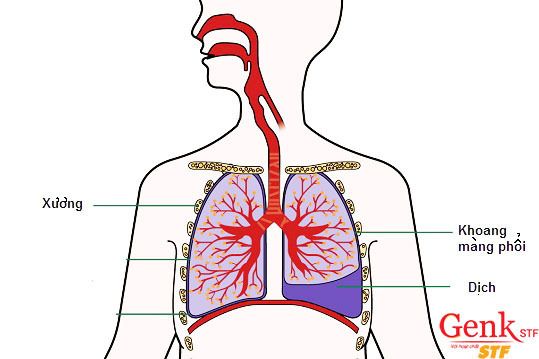 Ở nước ta số bệnh nhân mắc chứng tràn dịch màng phổi khá nhiều