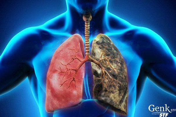 Điều trị bệnh ung thư phổi