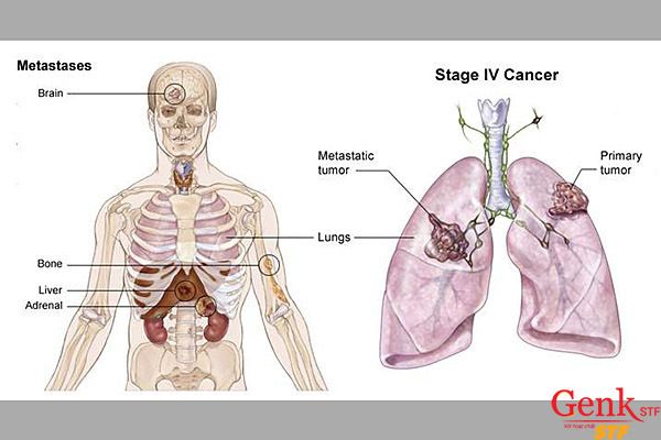 Ung thư phổi di căn xương được xác định là giai đoạn IV.