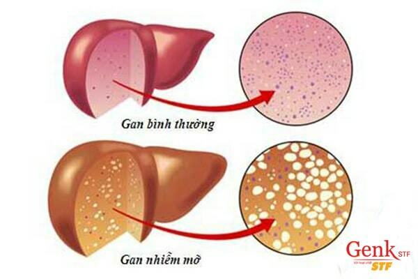 Gan nhiễm mỡ là bệnh thường gặp ở gan