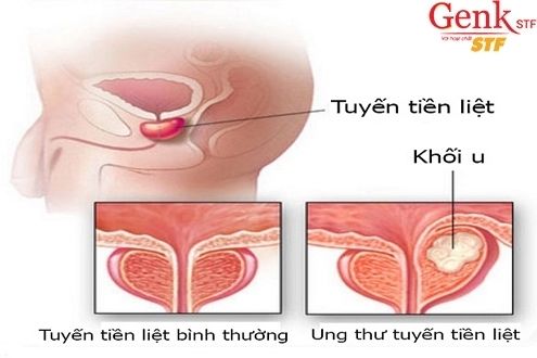 Nguyên nhân gây nên bệnh ung thư tuyến tiền liệt?