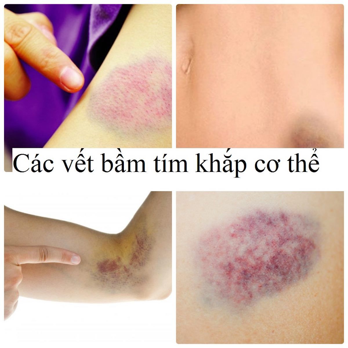 Những lời khuyên và chăm sóc sức khỏe tốt nhất cho bệnh nhân bị bệnh máu trắng giai đoạn cuối là gì?