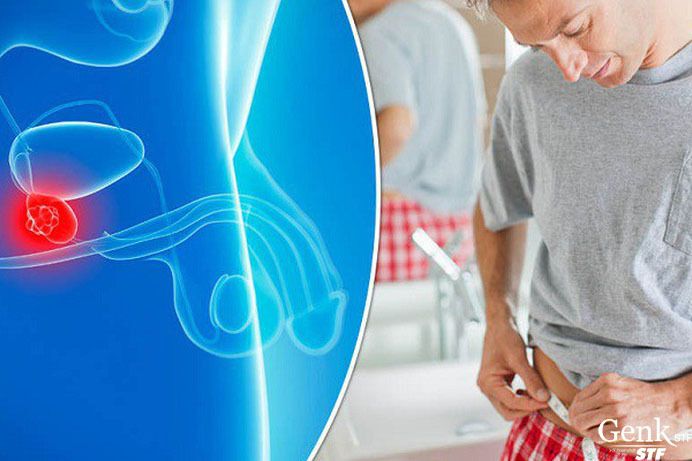 Dấu hiệu ung thư tuyến tiền liệt