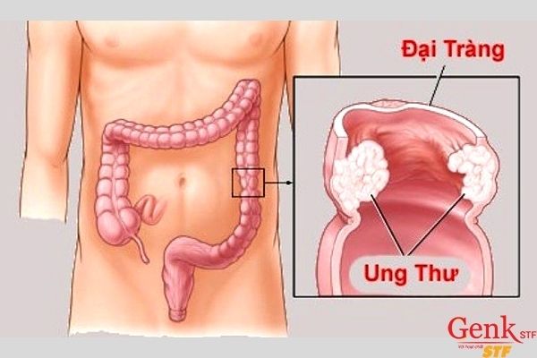 Sự phát triển đáng sợ của bệnh ung thư đại tràng như thế nào?