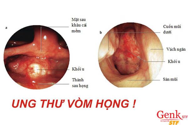 Bệnh ung thư vòm họng hoàn toàn có thể chữa trị triệt để nếu được phát hiện và điều trị sớm