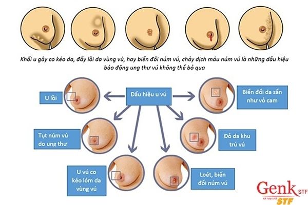 Những dấu hiệu nhận biết sớm bệnh ung thư vú