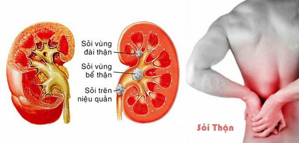 Các yếu tố khác như sỏi thận và tăng huyết áp có thể gây nguy cơ ung thư thận