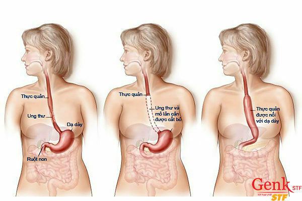 Kết hợp các loại điều trị khác nhau: xạ trị, hóa trị và phẫu thuật để điều trị ung thư thực quản