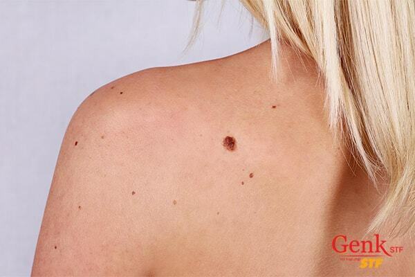 Nốt ruồi cảnh báo ung thư da khác với nốt ruồi thông thường