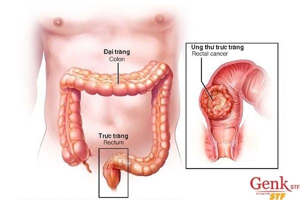 Tầm soát sớm – Tấm vé vàng ngăn ngừa bệnh ung thư