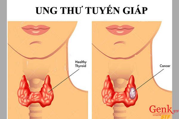 Tầm soát ung thư tuyến giáp ở thể nhú