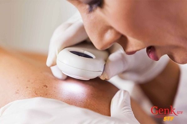 Ung thư da là 1 trong 7 loại ung thư dễ chữa
