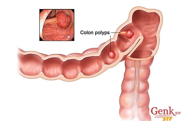 Phương pháp điều trị ung thư đại tràng giai đoạn cuối
