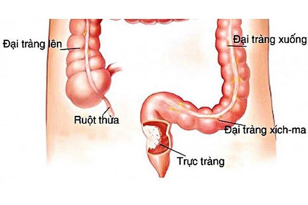 Dấu hiệu nhận biết sớm ung thư trực tràng