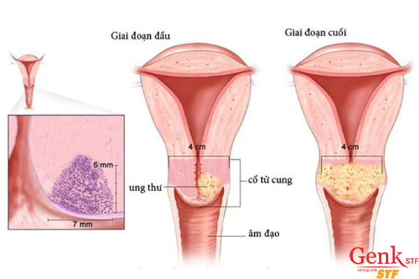 Tiêm Vaccine ngừa ung thư cổ tử cung càng sớm sẽ đạt hiệu quả càng cao.