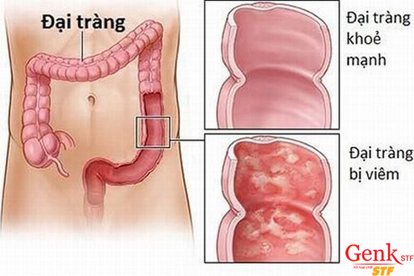 Khó thở là 1 trong những dấu hiệu ung thư đại tràng khi di căn