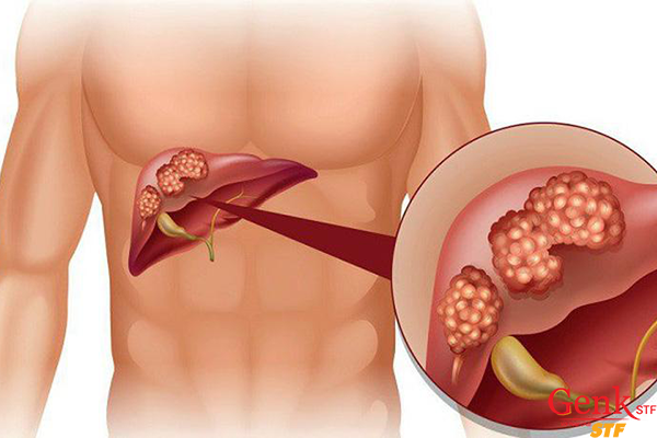 Dấu hiệu ung thư gan giai đoạn cuối bạn nên biết