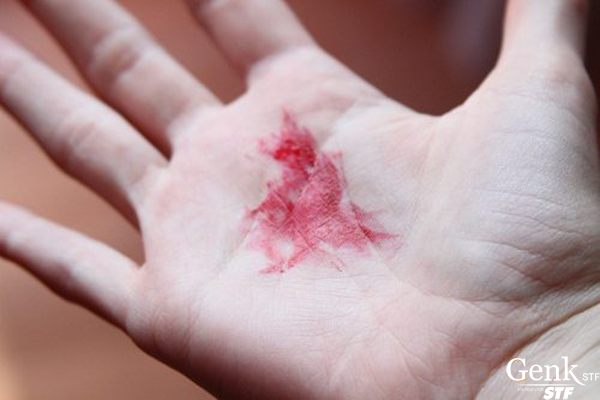 Dấu hiệu ho ra máu báo hiệu căn bệnh ung thư thực quản giai đoạn cuối