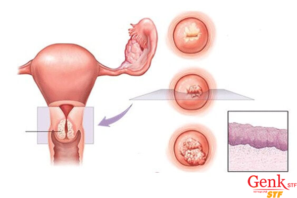 Những nguy cơ nào khiến ung thư cổ tử cung tái phát?
