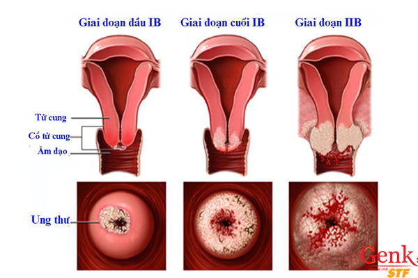 Ung thư cổ tử cung đe dọa đến tính mạng nhiều chị em phụ nữ