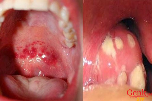Nguyên nhân nào gây thư vòm họng