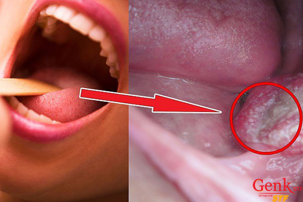 Những triệu chứng giai đoạn đầu của ung thư vòm không thể bỏ qua