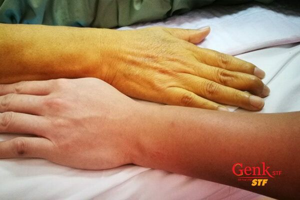 Vàng da là biểu hiện đầu tiên báo hiệu ung thư gan