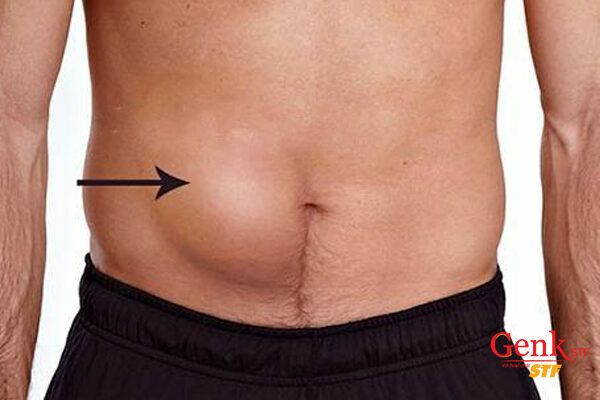 Gan to bất thường là dấu hiệu của ung thư gan