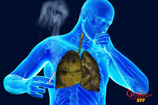Ho dai dẳng là dấu hiệu cảnh báo ung thư phổi