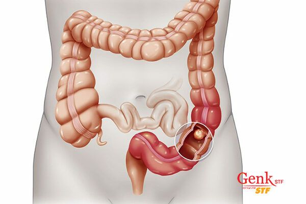 Khối u sẽ bám dính vào thành ruột, gây tắc ruột