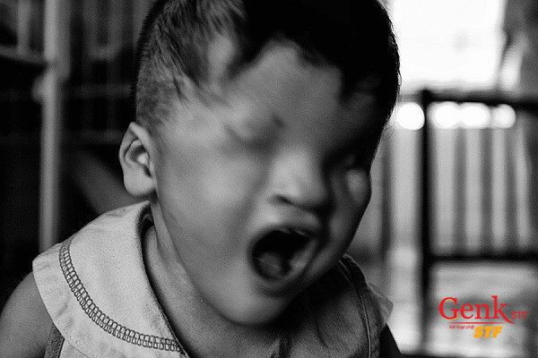 Chất độc da cam là nỗi đau không chỉ của các bệnh nhân ung thư máu