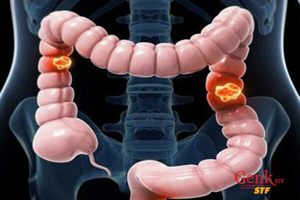 Những người thường xuyên ăn vặt có khả năng phát triển khối u đại tràng cao gấp đôi.
