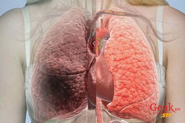 Dựa trên các triệu chứng ung thư gan, bạn sẽ được bác sĩ chỉ định các xét nghiệm sàng lọc để đưa ra phương pháp điều trị thích hợp.