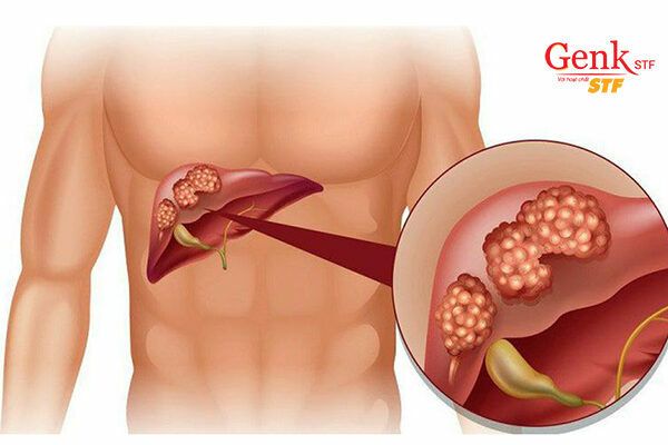 Nhiều khối u trong gan khiến việc phẫu thuật trở nên khó khăn