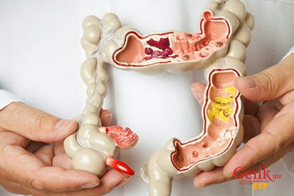 Ung thư đại trực tràng là ung thư phổ biến trên thế giới.