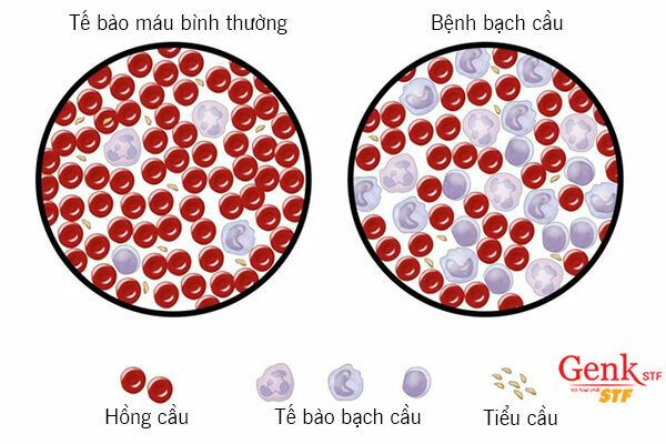Cơ thể tạo ra quá nhiều tế bào bạch cầu bất thường gây ra bệnh bạch cầu