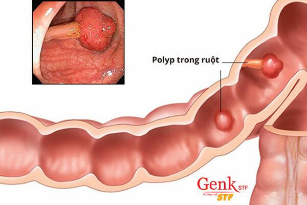 Hầu hết các bệnh ung thư ở đại tràng hoặc trực tràng phát triển từ polyp