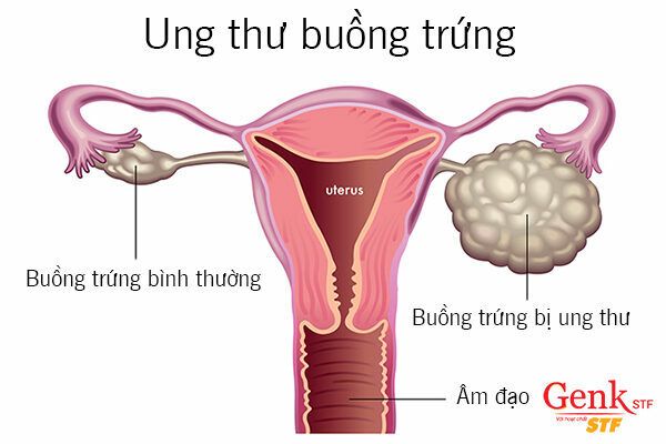 Mô phỏng ung thư buồng trứng