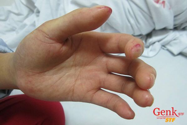 Phụ nữ bị xơ cứng bì có nguy cơ mắc ung thư bàng quang cao hơn
