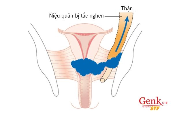 Ung thư cổ tử cung di căn lên thận gây tắc nghẽn niệu quản