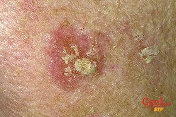 Dày sừng quang hóa gây ra bởi tiếp xúc với ánh nắng mặt trời nhiều năm