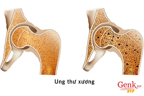 Ung thư xương là ung thư liên kết (sacôm) xuất phát từ tế bào tạo xương, tạo sụn, tế bào mô liên kết của xương.