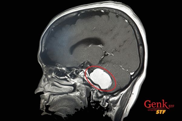 Các triệu chứng phụ thuộc vào vị trí của khối u và cách nó ảnh hưởng đến phần của não
