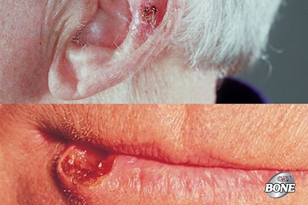 Ung thư biểu mô tế bào vảy của da thường xuất hiện ở mặt, tai và tay của bạn