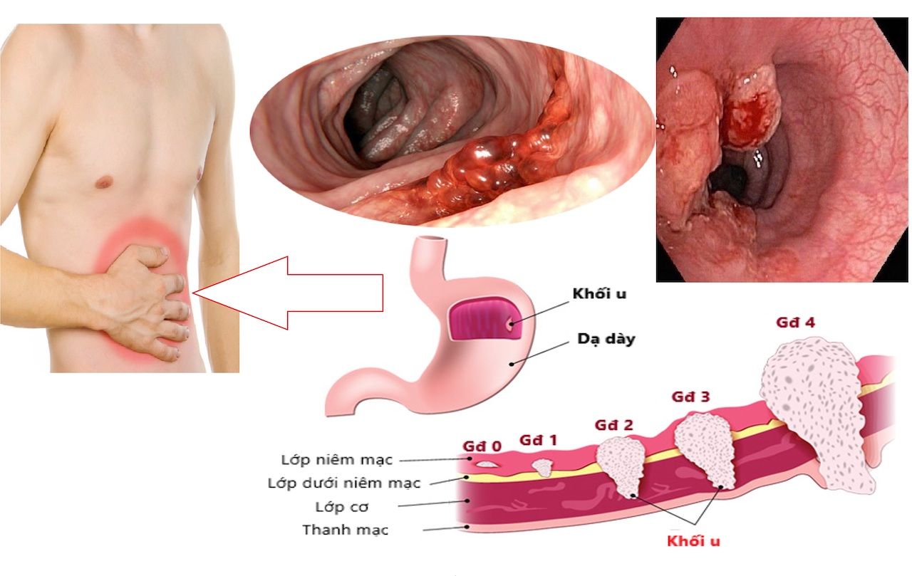 Các giai đoạn phát triển ung thư dạ dày