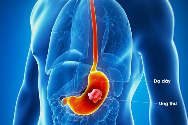Ung thư dạ dày là một trong những ung thư phổ biến trên thế giới