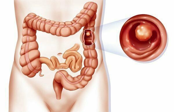 polyp đại tràng